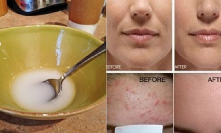 Olio da forno e maschera all'olio di cocco per rimuovere l'acne e le imperfezioni